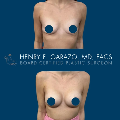 Breast augmentation patient result by Dr. Garazo Hagerstown Maryland