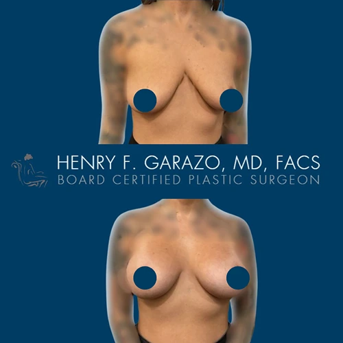 Breast augmentation result 2