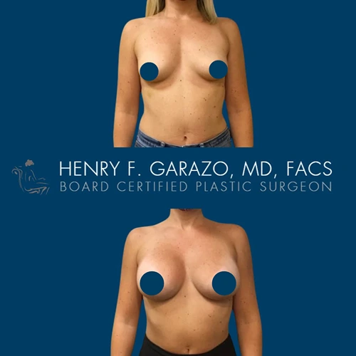 Breast augmentation result 3