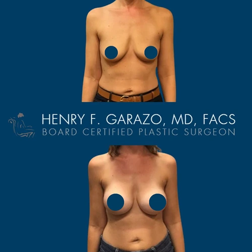 Breast augmentation result 4