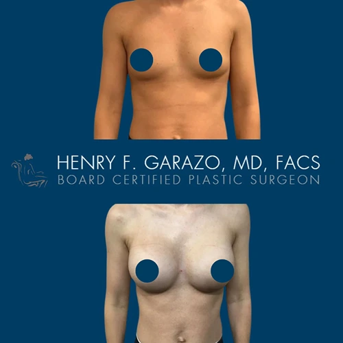Breast augmentation result 6