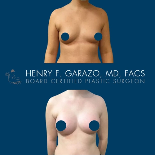 Breast augmentation result 7