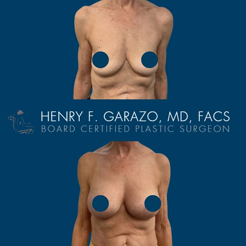 Breast augmentation result 8